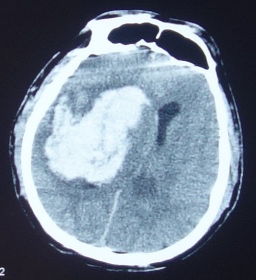 大面积脑出血图片