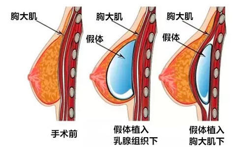 取出后多长时间恢复呢?
