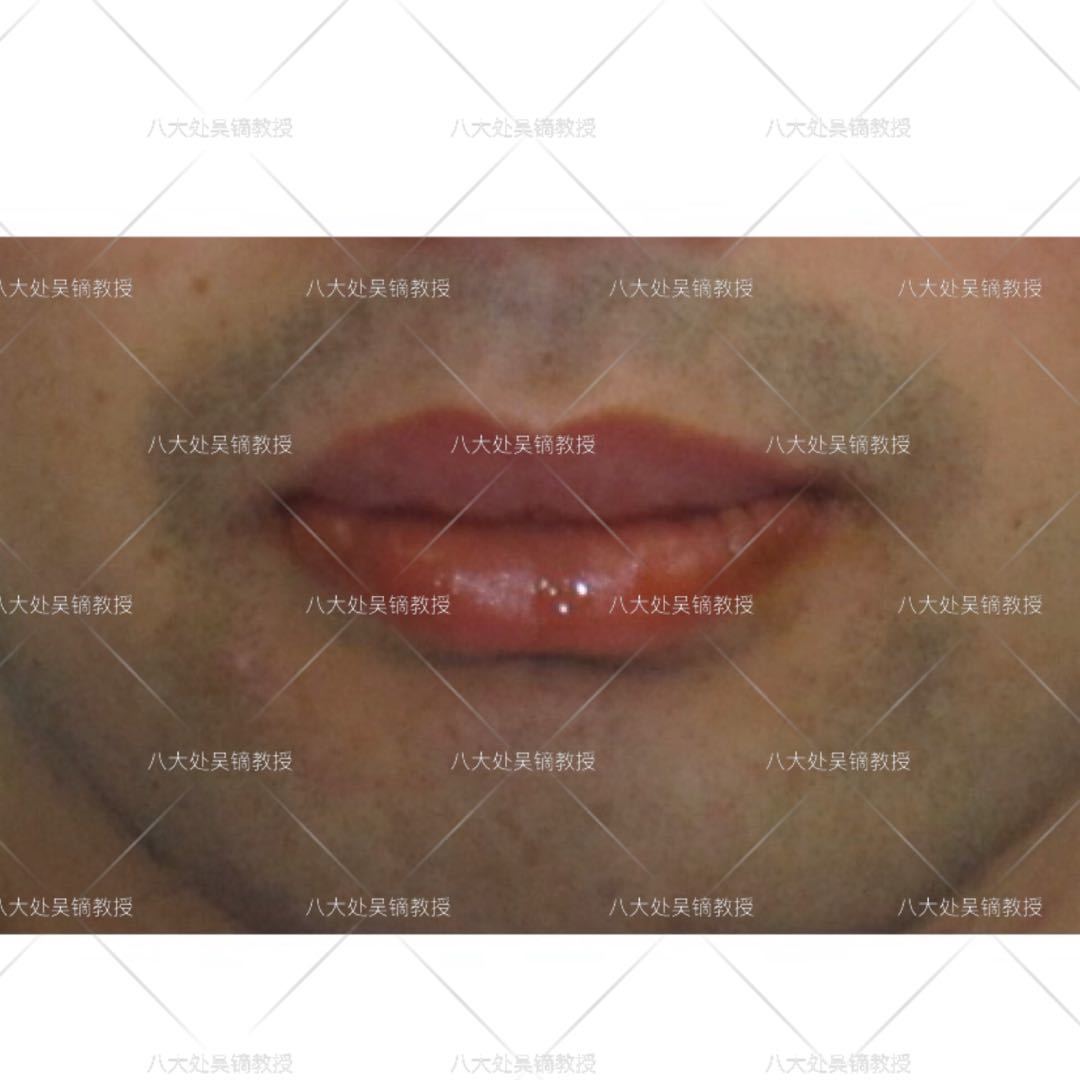 厚唇修薄手术是怎么做的？（含案例）_唇部整形_唇部整形治疗介绍 - 好大夫在线
