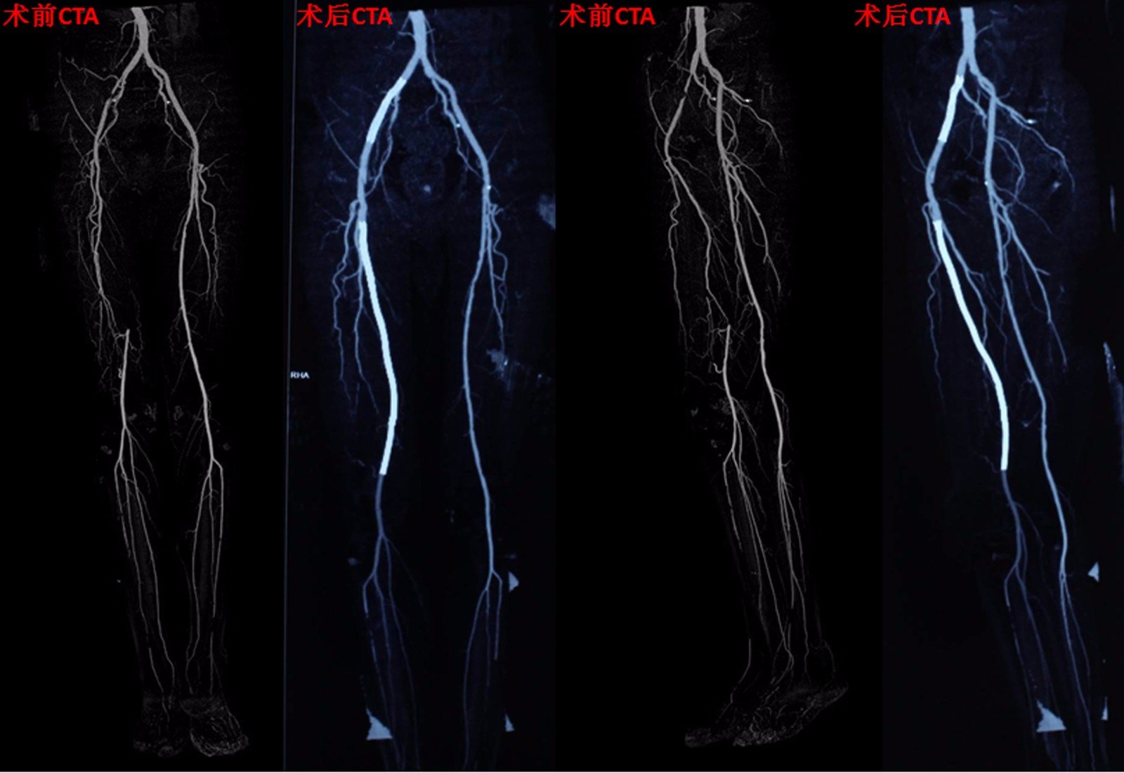 下肢动脉硬化闭塞症发病率逐年增加,是常见的血管外科疾病之一,主要