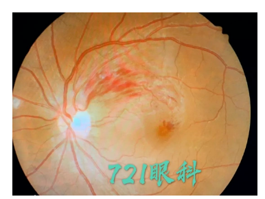各种原因导致的视网膜,脉络膜新生血管形成老年性黄斑变性,糖尿病性