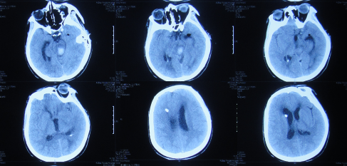 急診到山東省日照市某醫院,查頭顱ct: