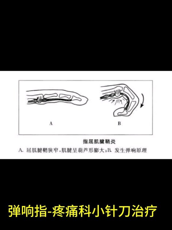 超声引导下小针刀治疗狭窄性腱鞘炎，精准，快捷