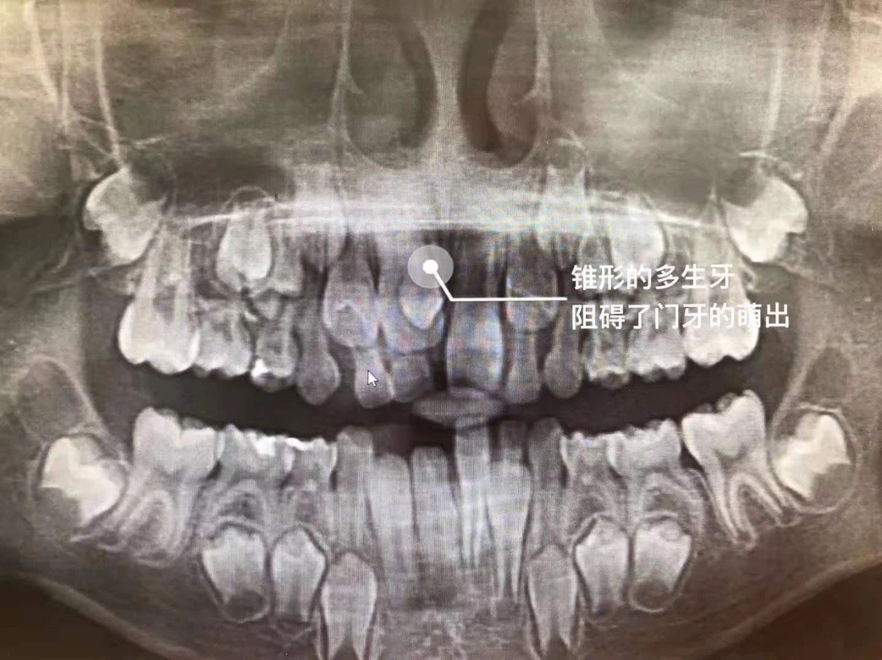 乳牙恒牙x光图片