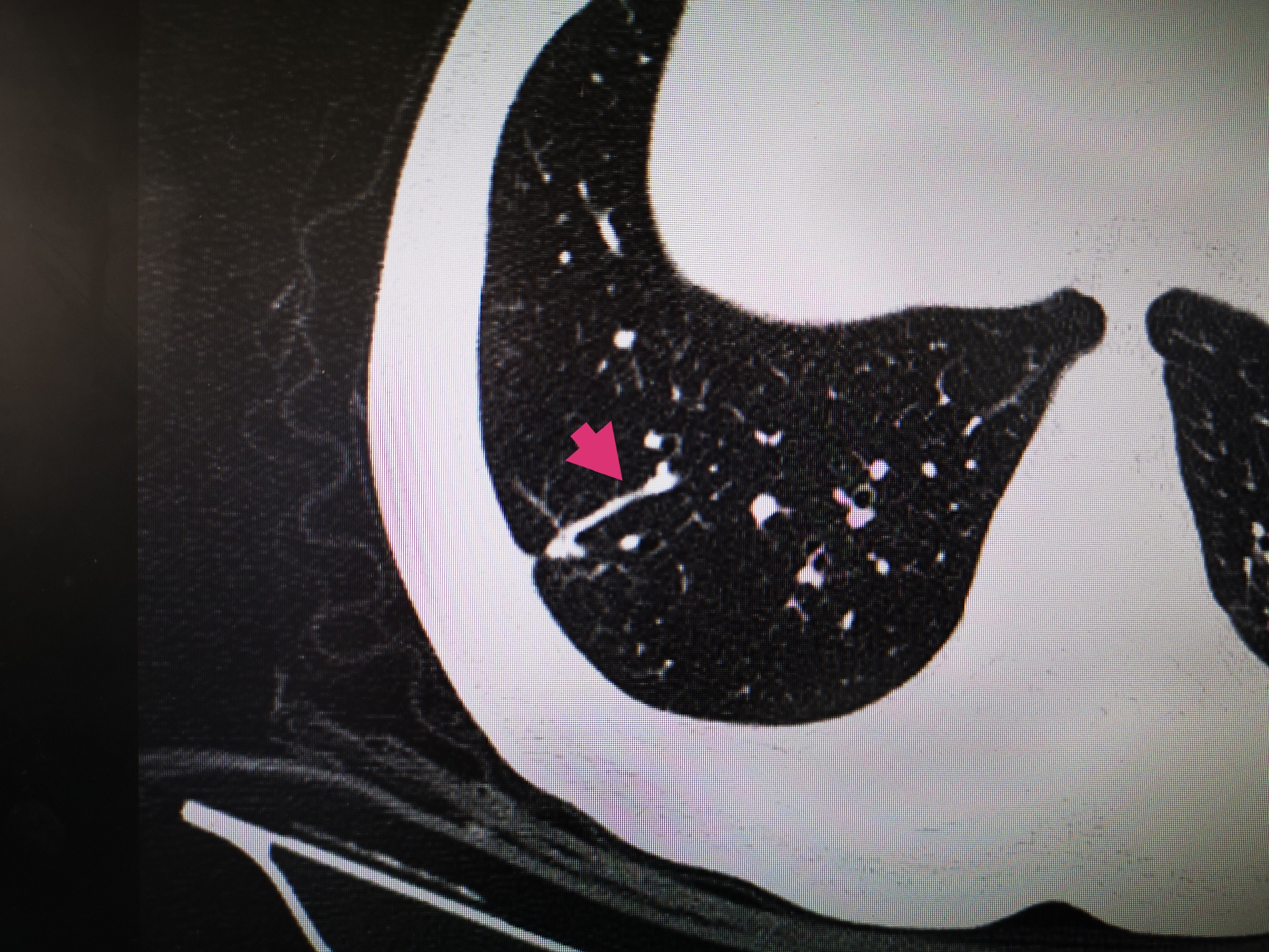 肺部结节 肺部结节