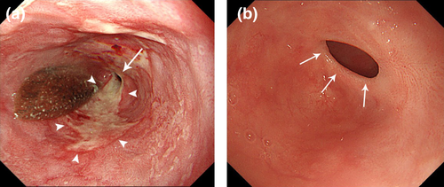 放射状切开治疗难治性食管良性狭窄