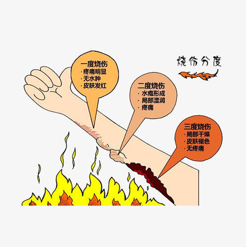 发生火灾烧伤怎么办应对症进行急救处理