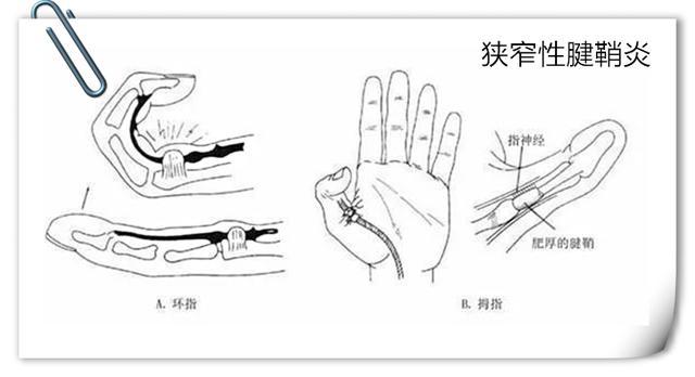 狭窄性腱鞘炎手术图解图片