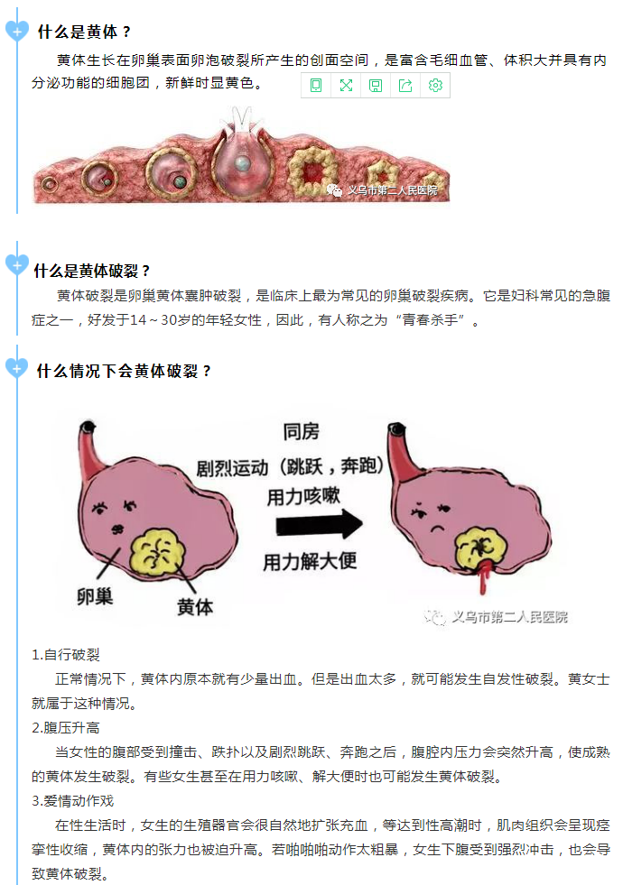 妇科急腹症 下腹剧痛致晕厥 警惕黄体破裂 腹痛