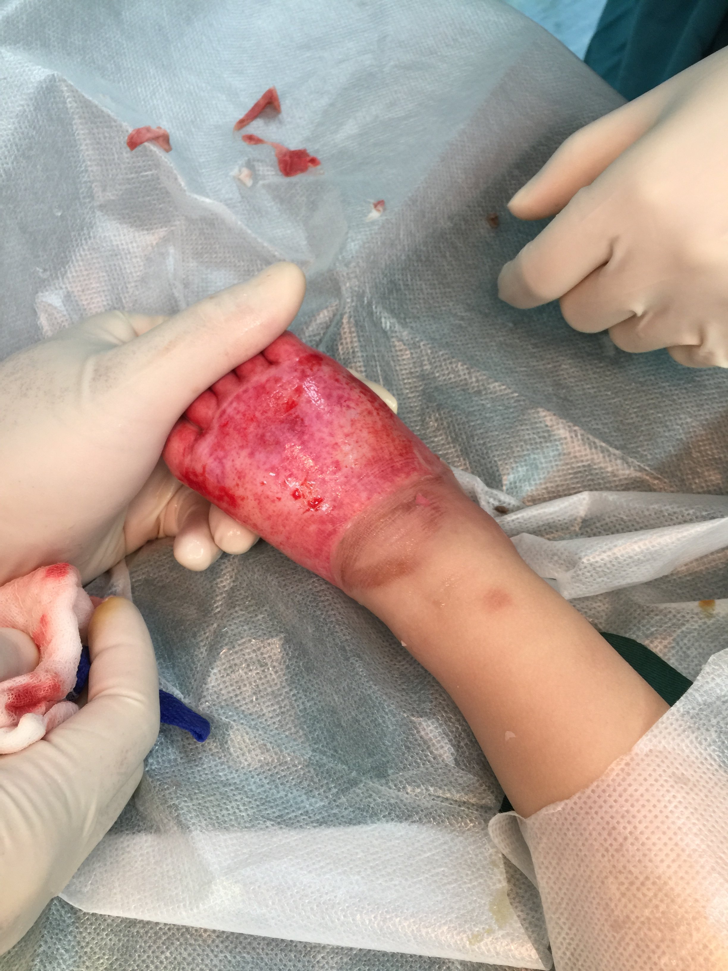 一岁儿童足背深度烧伤大张中厚皮移植效果