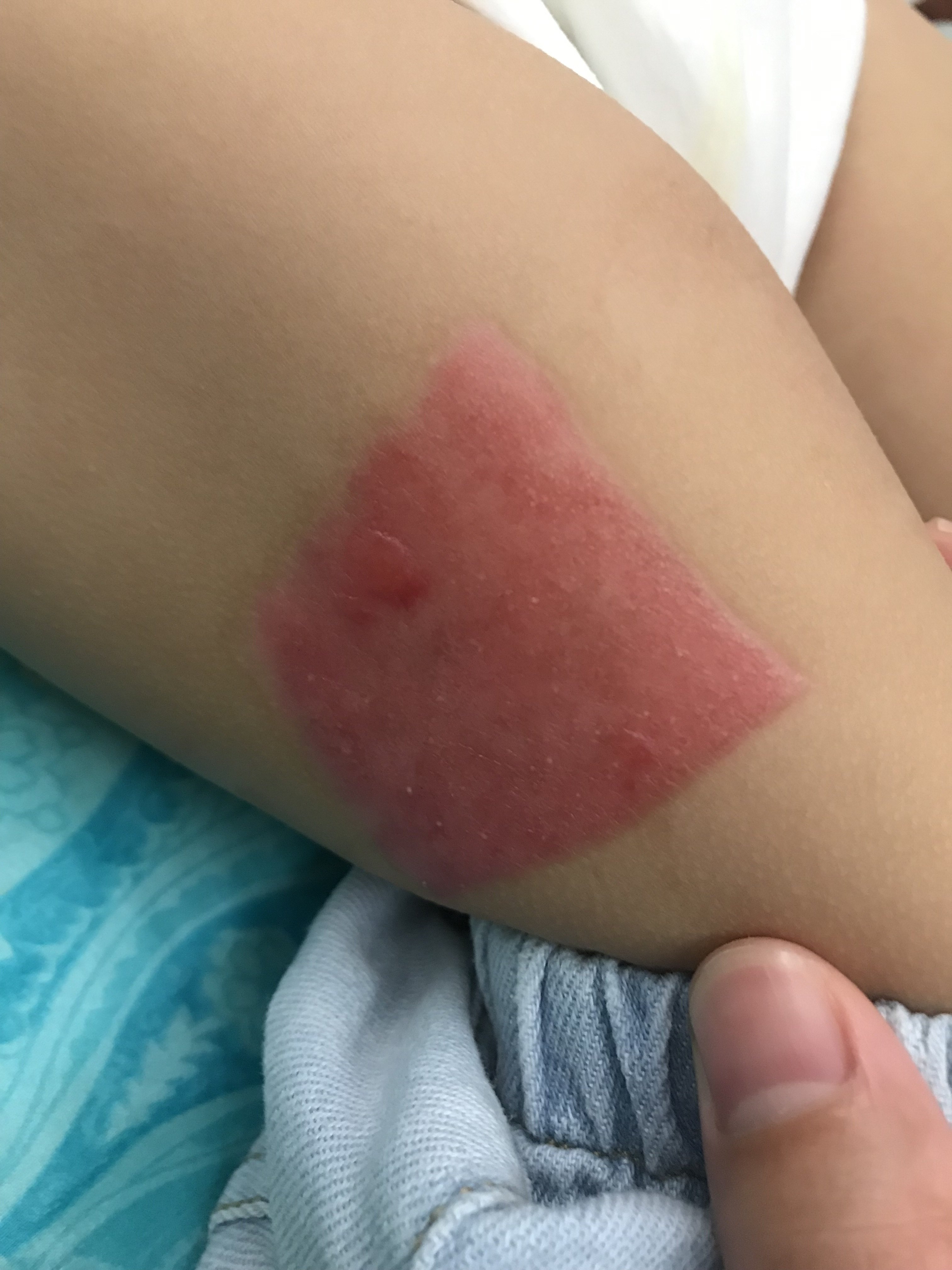 一岁儿童足背深度烧伤大张中厚皮移植效果