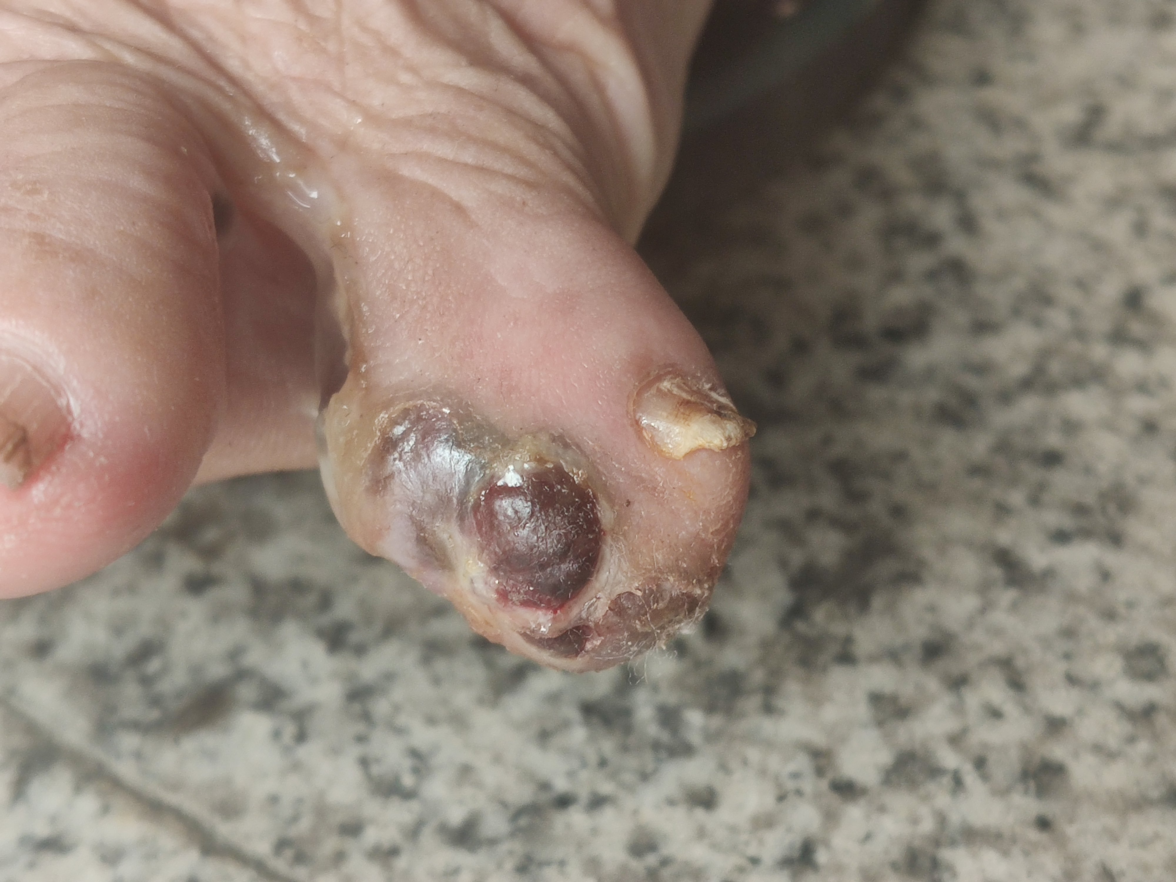 脚大拇指黑色素瘤图片