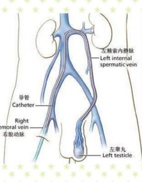 输精管,淋巴管,精索静脉是睾丸的回流血管,其出现曲张,为精索静脉曲张