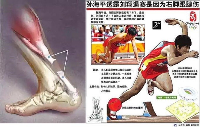 跟腱断裂是怎么回事 跟腱断裂 好大夫在线 跟腱断裂是怎么回事 跟腱断裂 好大夫在线