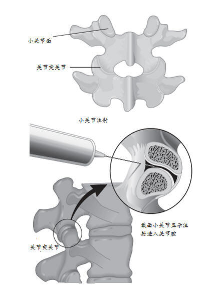 腰椎關節突關節病的椎間關節注射