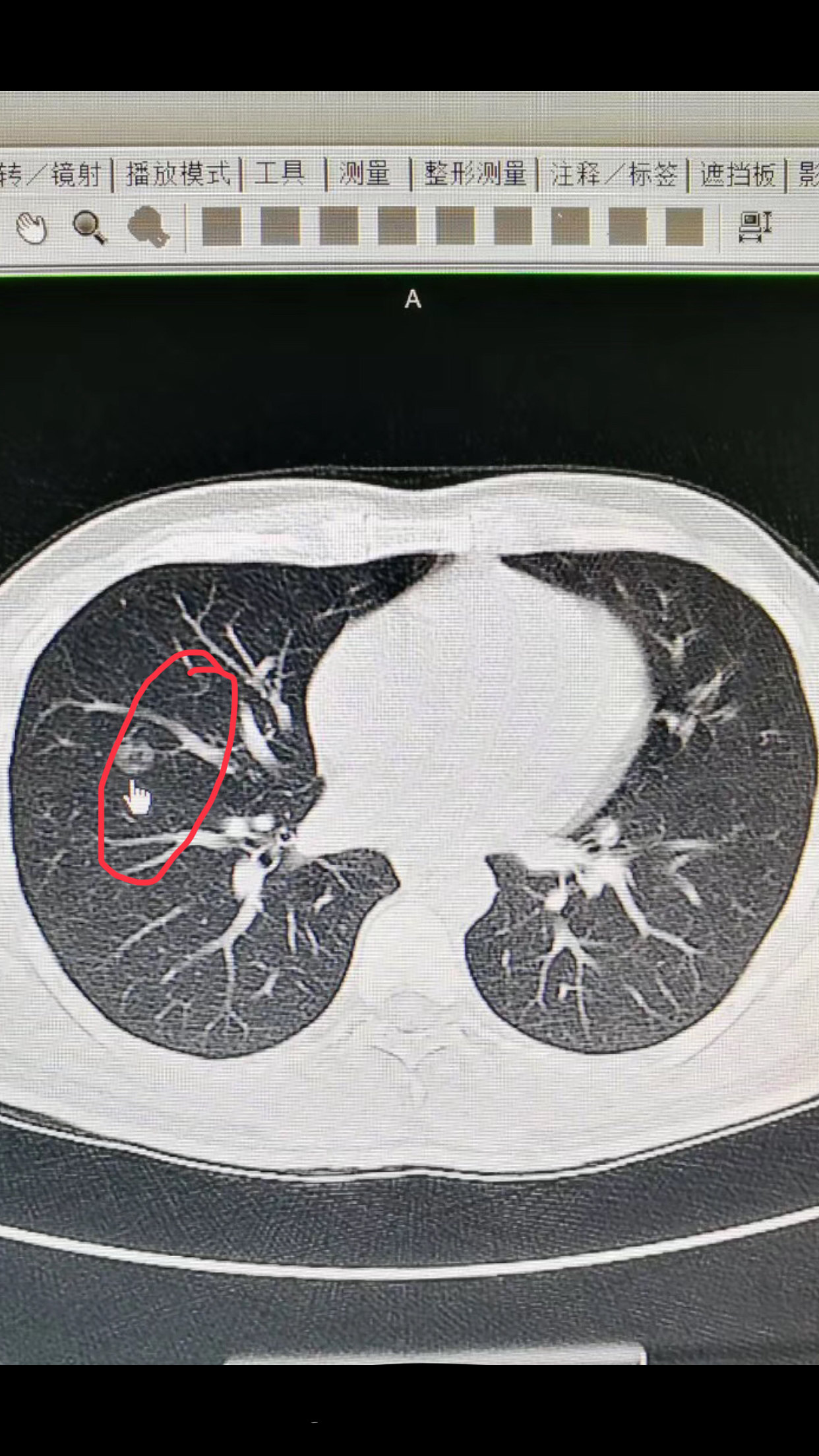 肺癌ct影像表现特点,正常肺ct - 伤感说说吧