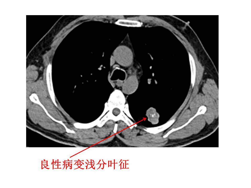 肺結節常見惡性徵象之分葉徵