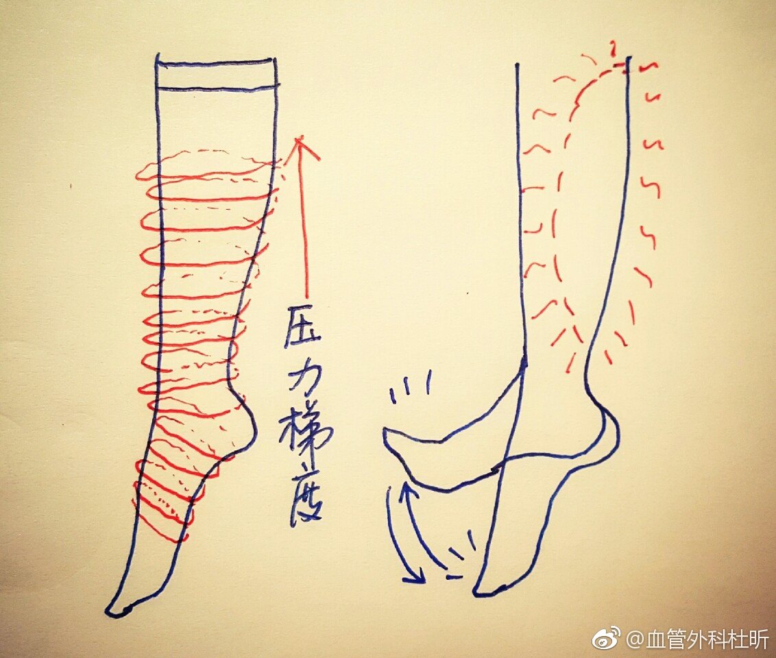 最常见的医用弹力袜,以及较贵的促血液循环机也就是间歇性充气加压泵