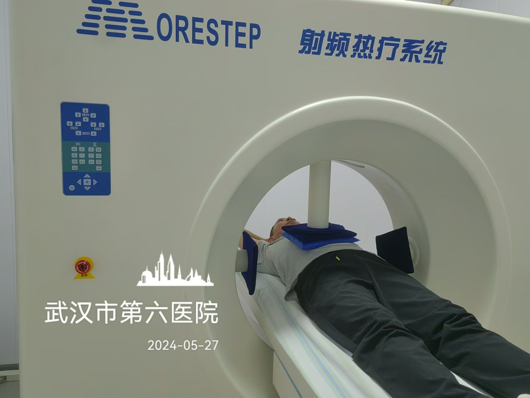 1例（男/56岁）肝内胆管细胞癌以局部治疗为先导的综合治疗-iSABR-5D TOMO放疗_肝内胆管癌_肝内胆管癌治疗方式 - 好大夫在线