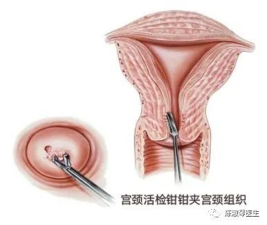 宫颈活检伤口图片图片
