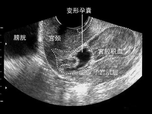 宫腔内囊性结构图片
