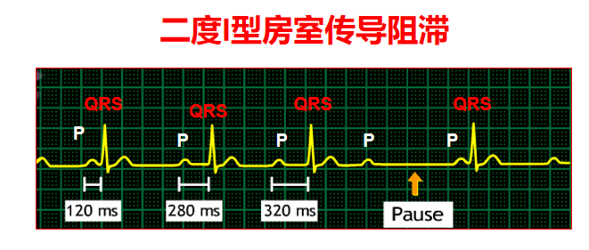 心电图双径路传导图片