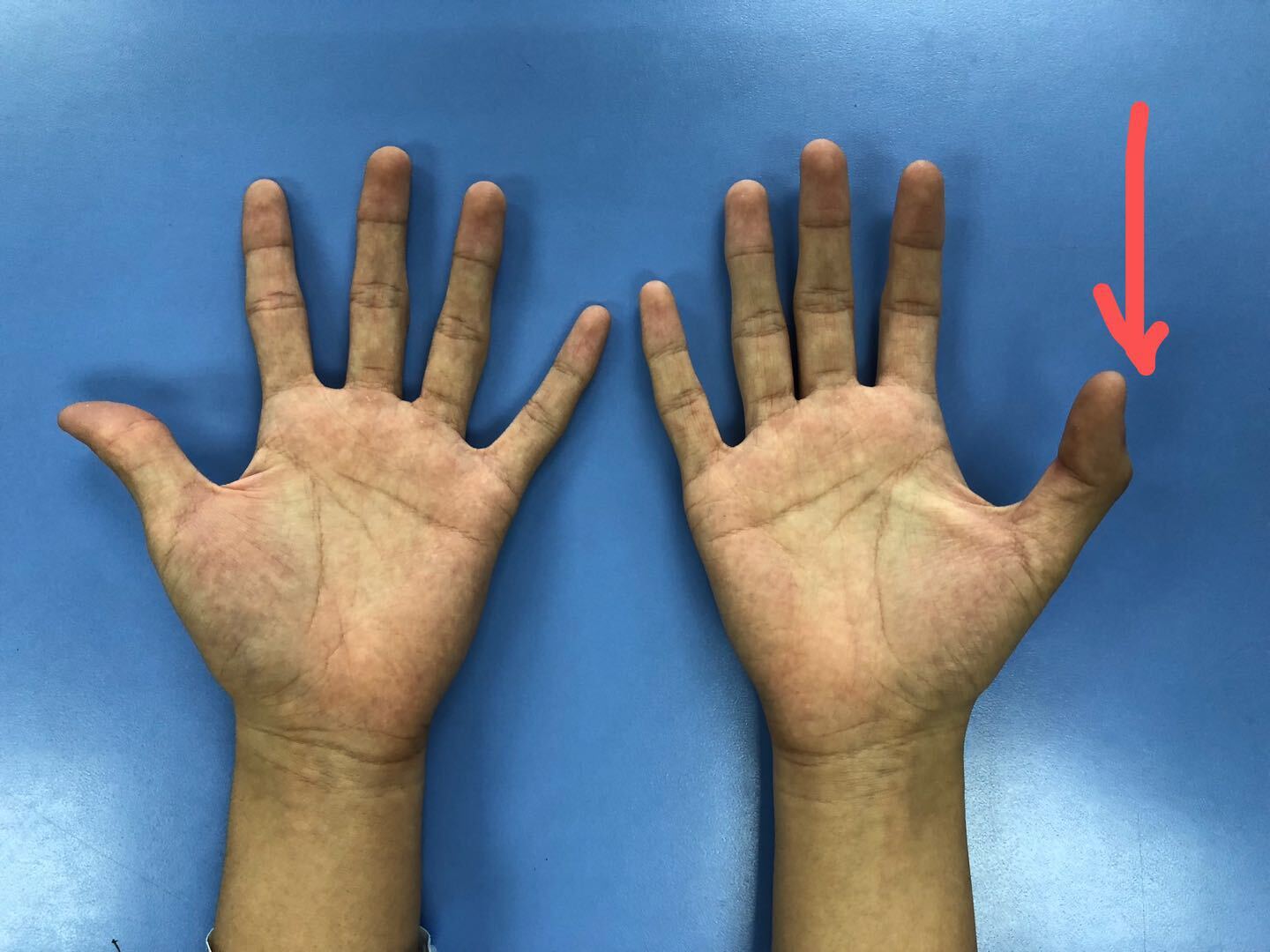 拇长伸肌腱损伤 肌腱移植 好大夫在线 拇长伸肌腱损伤 肌腱移植 好大夫在线