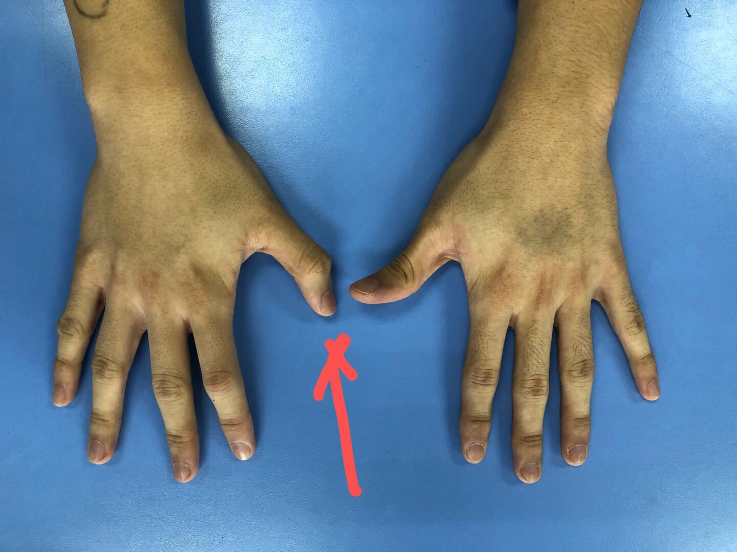 拇长伸肌腱损伤 肌腱移植 好大夫在线 拇长伸肌腱损伤 肌腱移植 好大夫在线