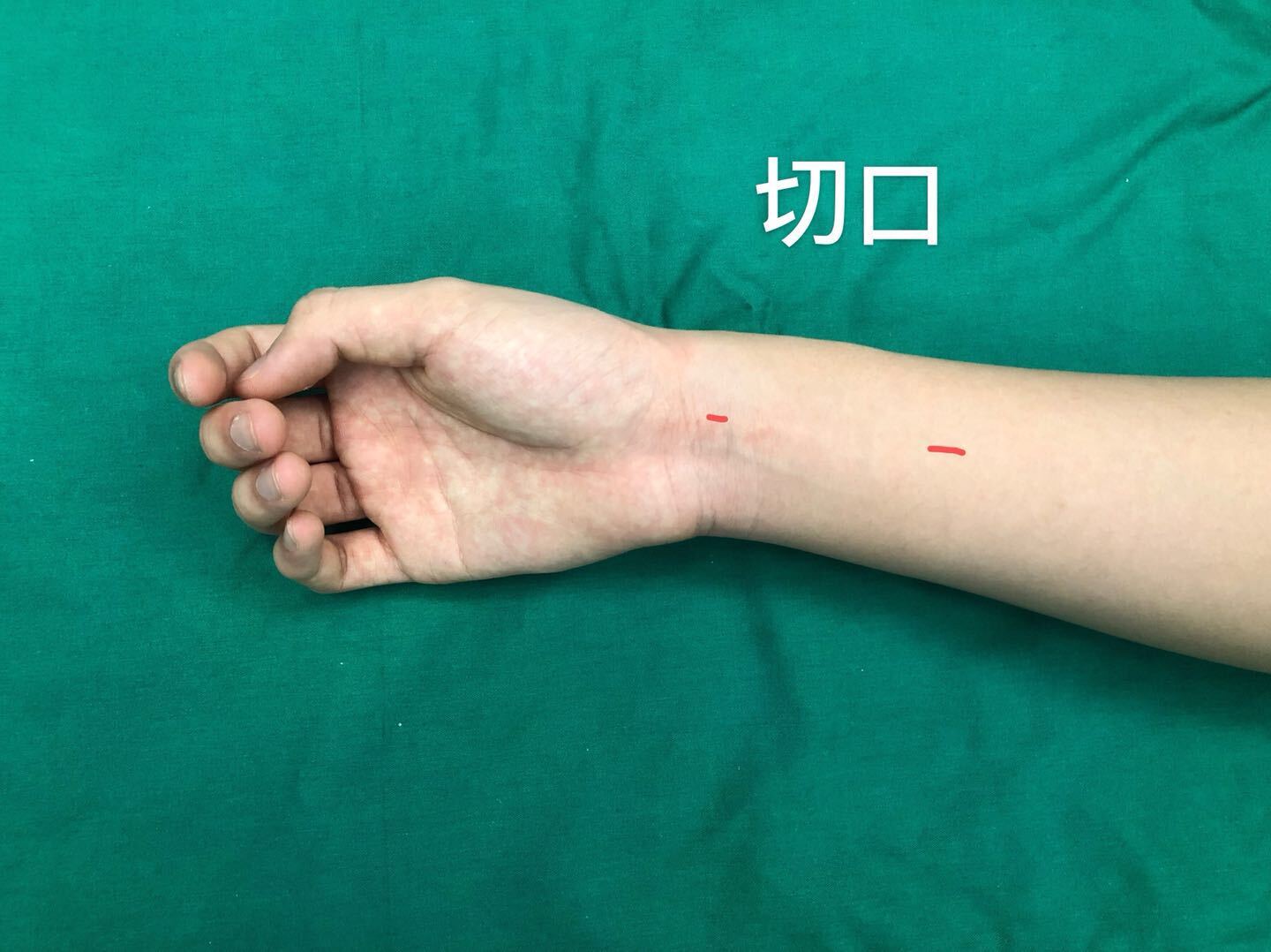 拇长伸肌腱损伤 肌腱移植 好大夫在线 拇长伸肌腱损伤 肌腱移植 好大夫在线