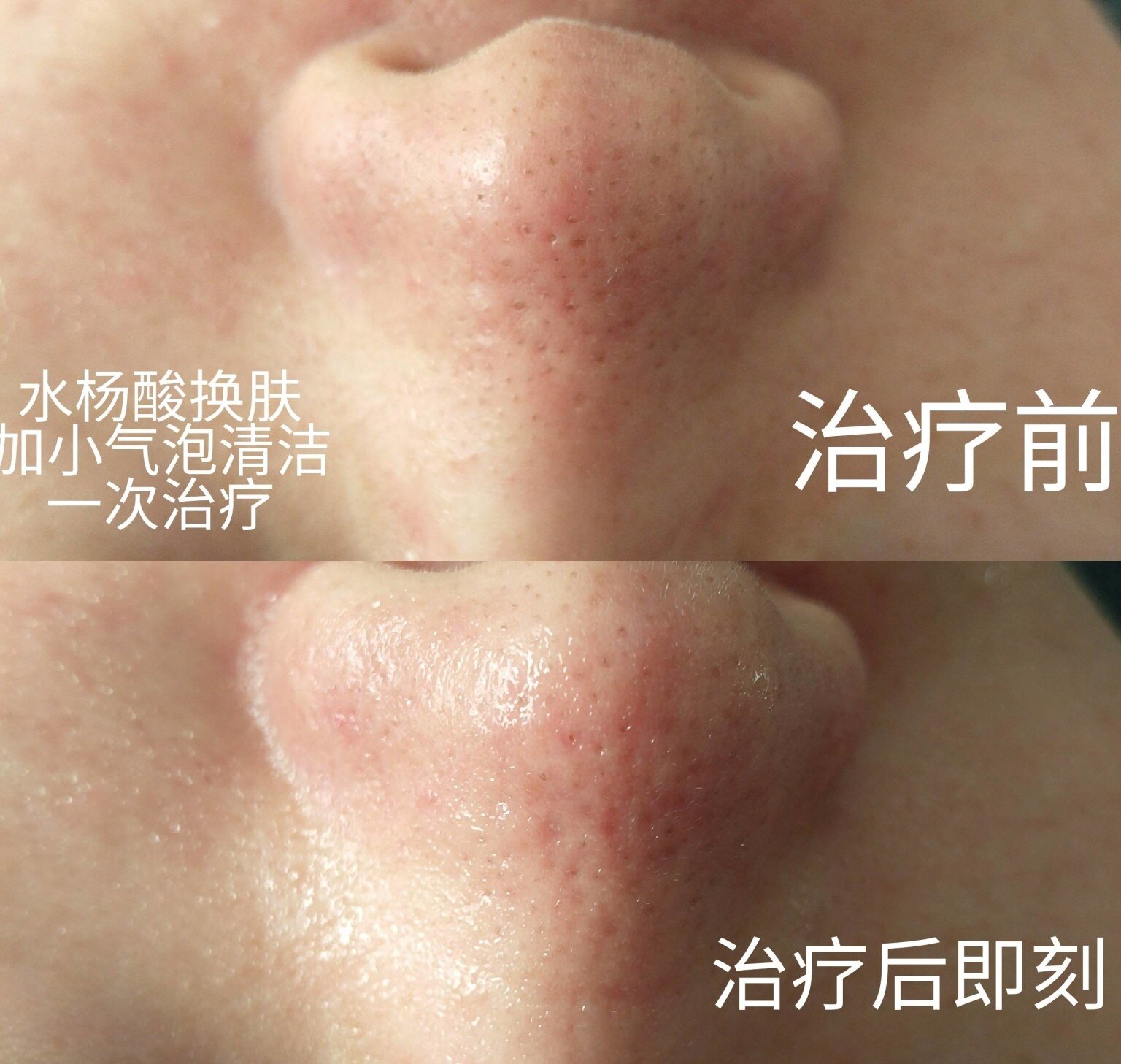 果酸换肤产品有哪些_果酸换肤产品_果酸换肤产品怎么自己使用