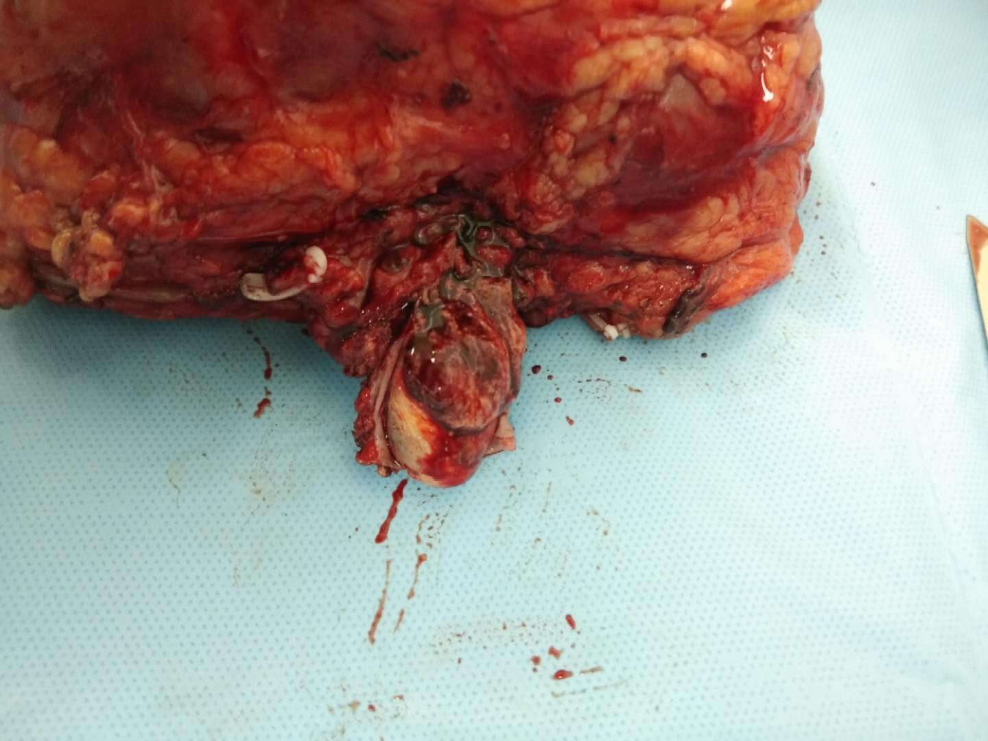 左肾癌伴左肾静脉0b级癌栓手术治疗 - 好大夫在线