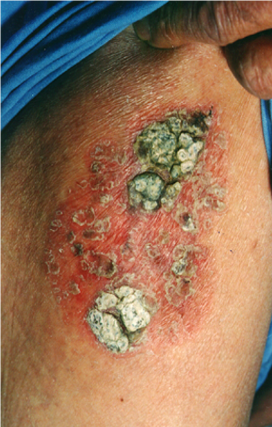 皮肤上持续不消退的小斑块,需要警惕鲍温病——一种早期鳞状细胞癌!