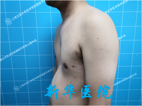 漏斗胸的有哪些治疗方法 轻度漏斗胸需要处理吗 中重度漏斗胸选择哪种手术方法 漏斗胸 漏斗胸 漏斗胸的有哪些治疗方法 轻度漏斗胸需要处理吗 中重度漏斗胸选择哪种手术方法 漏斗胸 漏斗胸