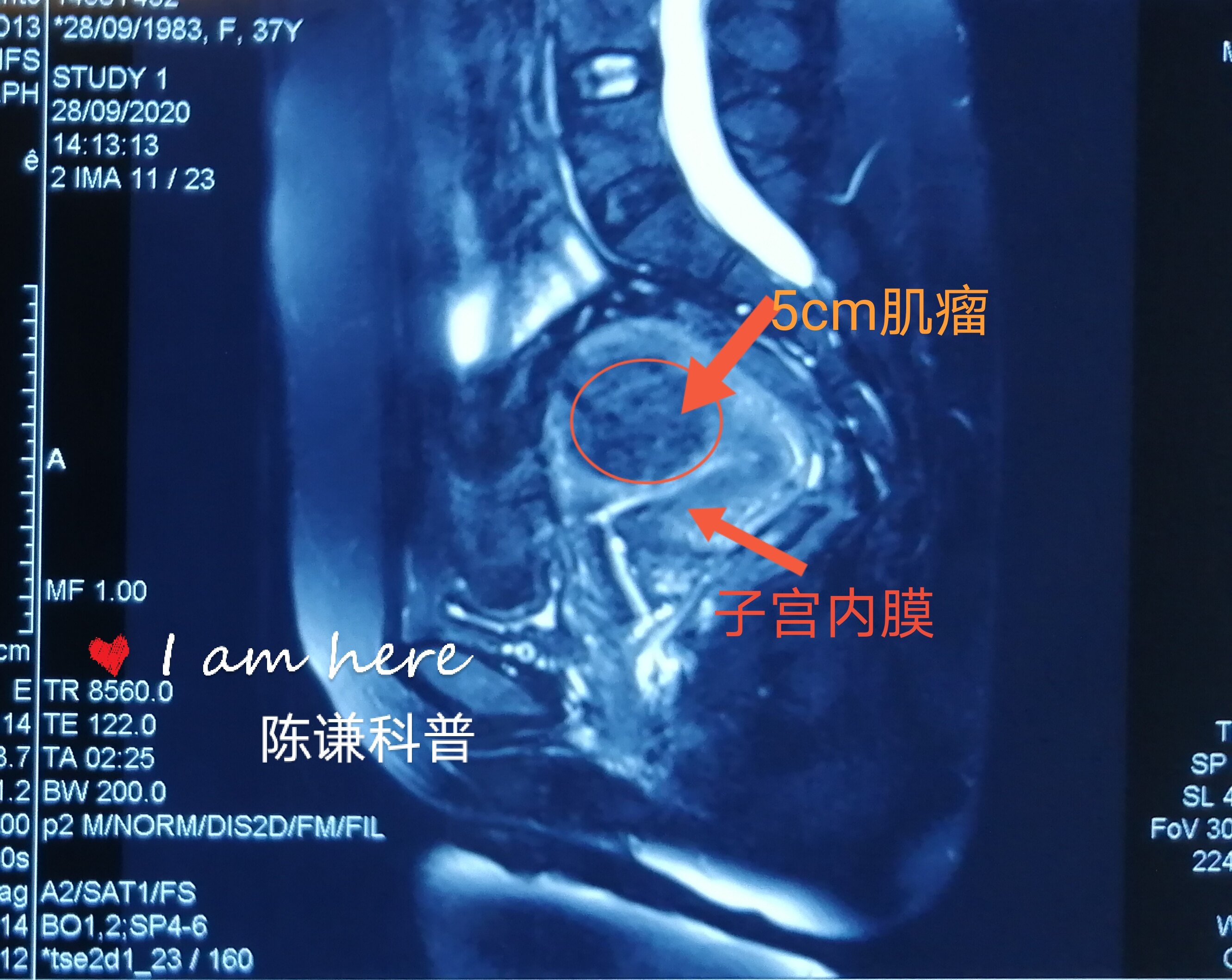 陈谦主任科普之子宫肌瘤诊治