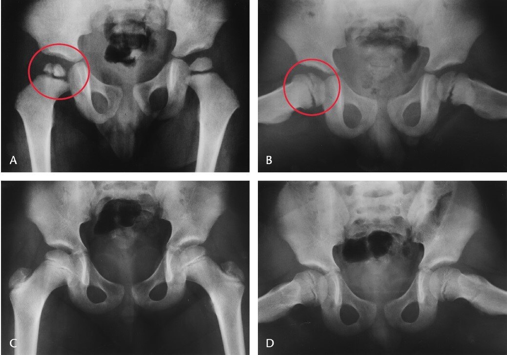 初步诊断为特发性儿童股骨头缺血坏死lcpd的小朋友要注意排查股骨头