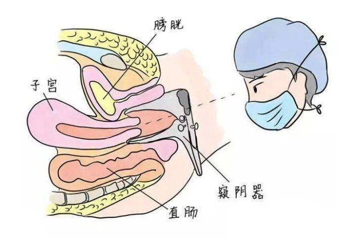 宫颈息肉的症状(宫颈炎和宫颈息肉的症状)-第2张图片-鲸幼网