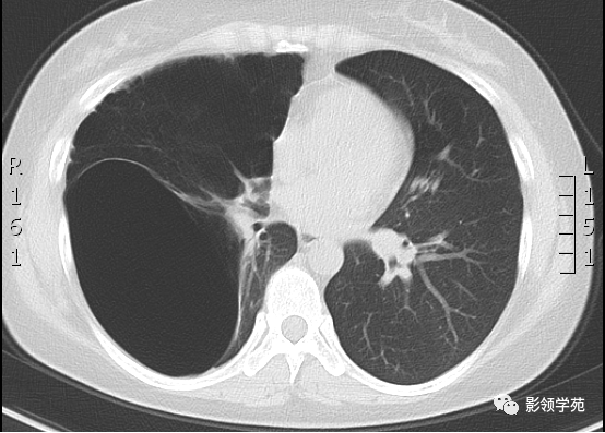 特别是脏层胸膜下肺大泡,在胸部ct扫描上清晰可见,ct可确切做出肺大泡