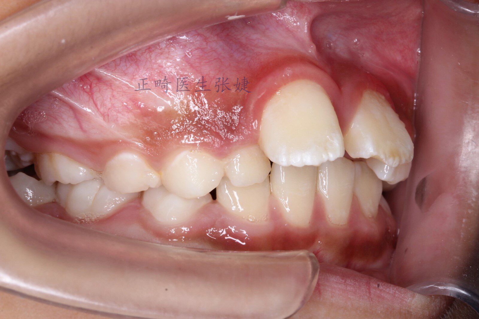 牙颌畸形_牙颌畸形治疗方式 - 好大夫在线