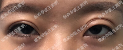 双眼皮失败的十种表现 下 双眼皮手术 双眼皮手术