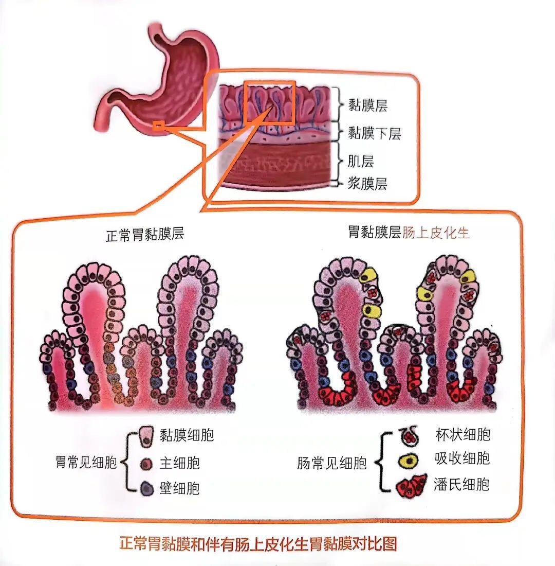 慢性胃炎:藏在胃里的慢性警报_慢性胃炎_介绍_发病原因_如何预防_治疗方式 - 好大夫在线