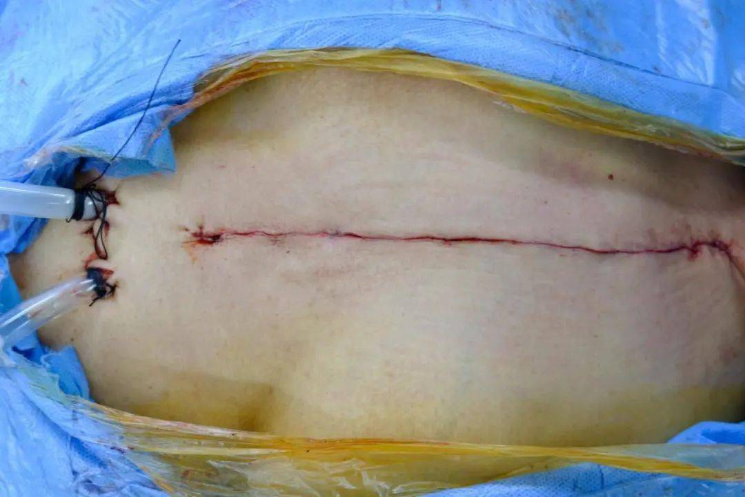 胸腺瘤手术图片图片