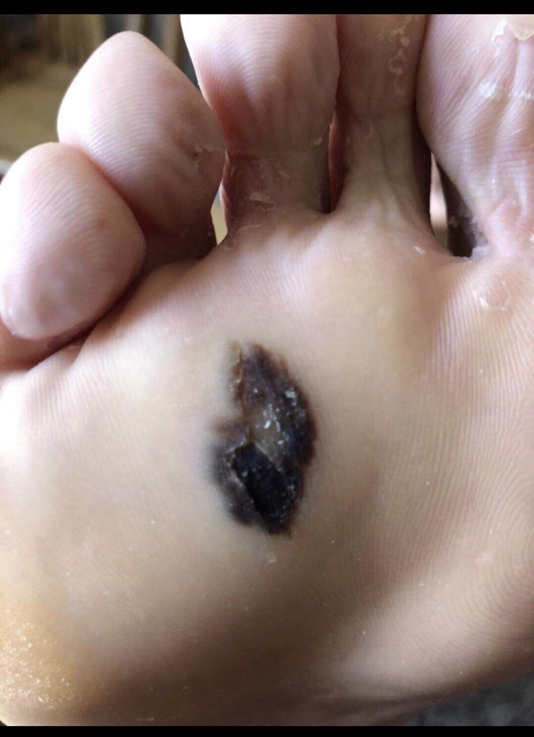 招募高危肢端恶黑患者|来自鼓楼医院肿瘤中心黑色素瘤亚专科的消息