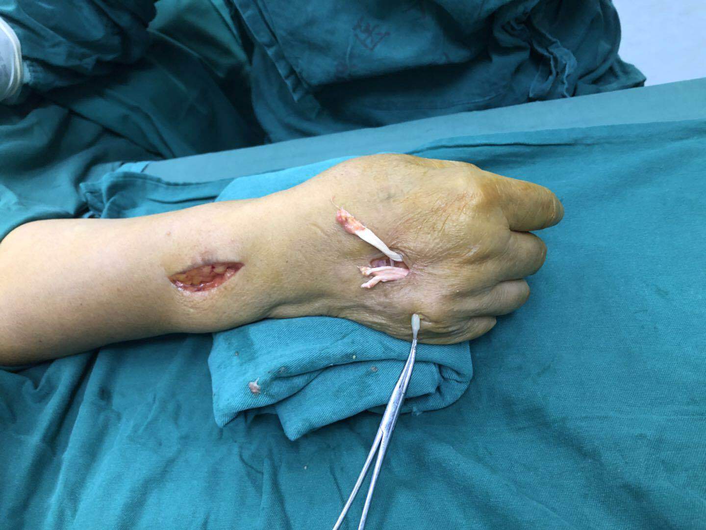 手部自发性肌腱断裂 好大夫在线 手部自发性肌腱断裂 好大夫在线