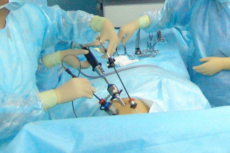 精索静脉曲张传统手术腹腔镜手术显微手术哪种术式是优选