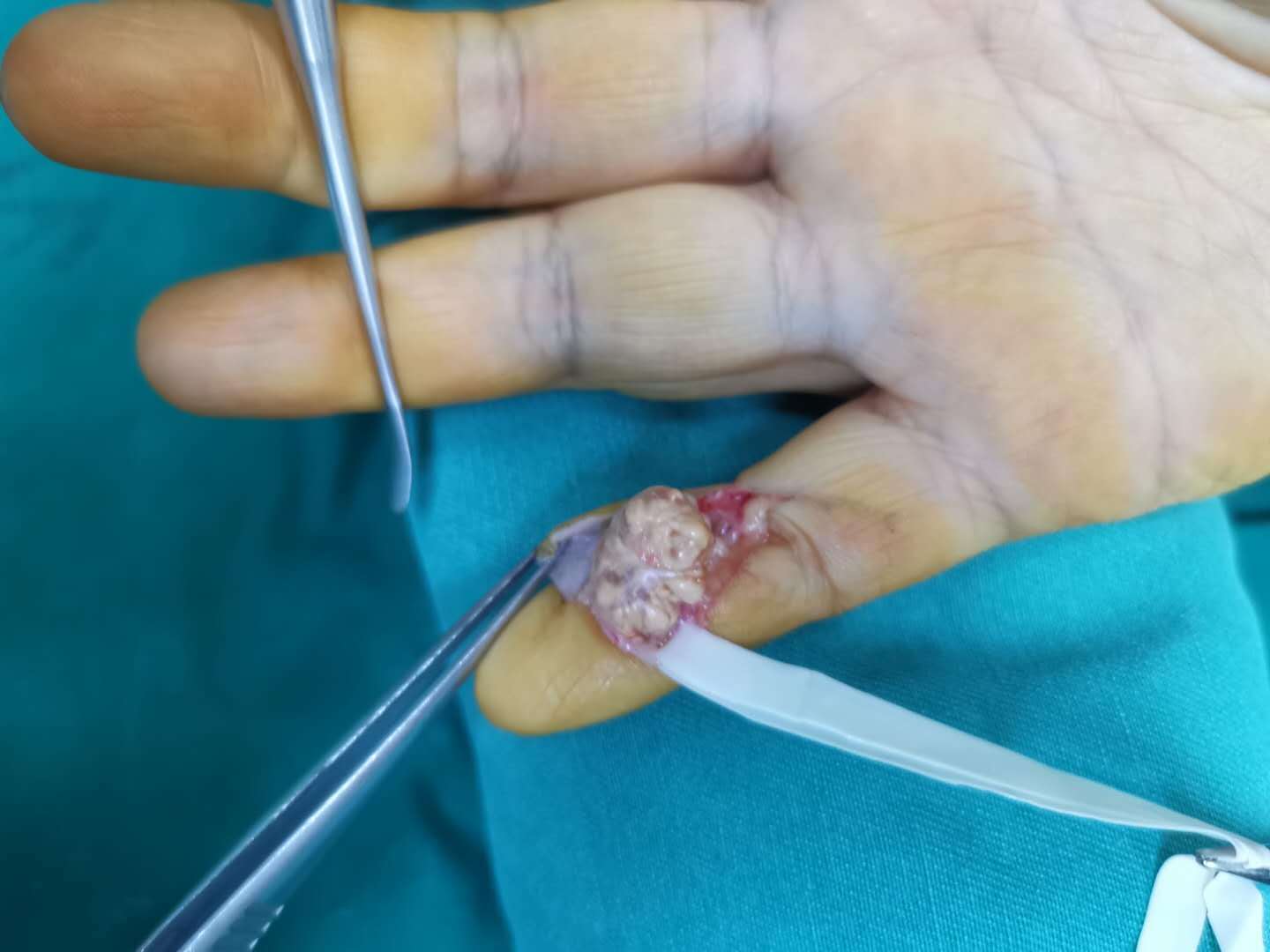 手部肿瘤初期图片