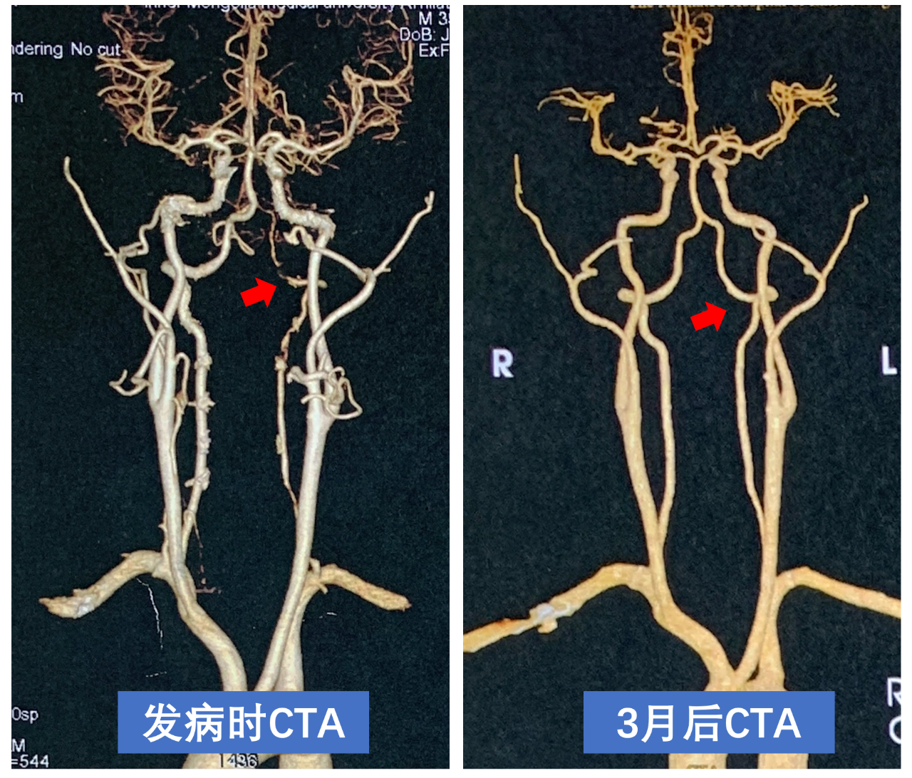 经典病例 | 神奇消失的椎动脉狭窄