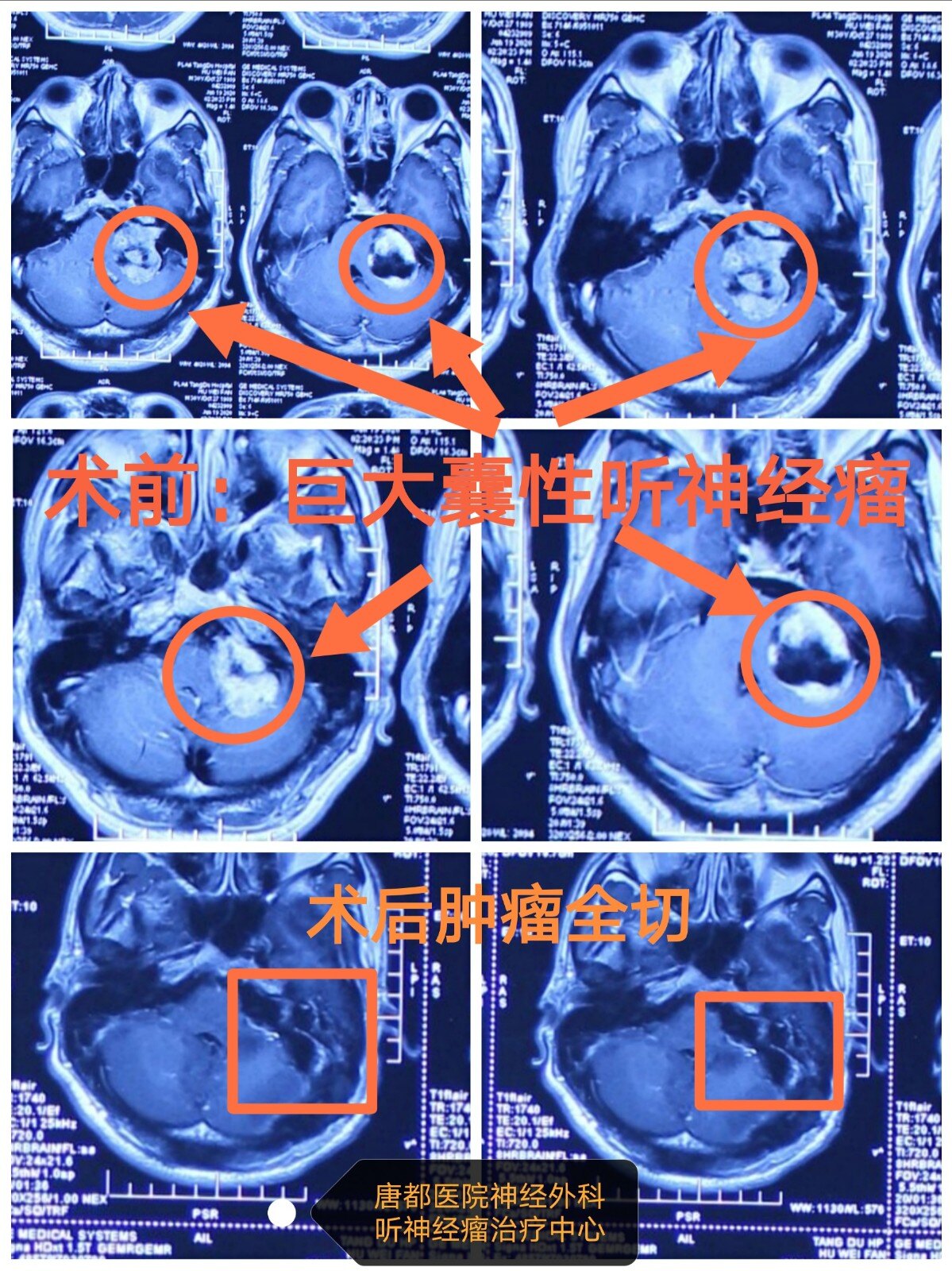 【病例】巨大囊性听神经瘤术后保留面神经功能 - 好大夫在线
