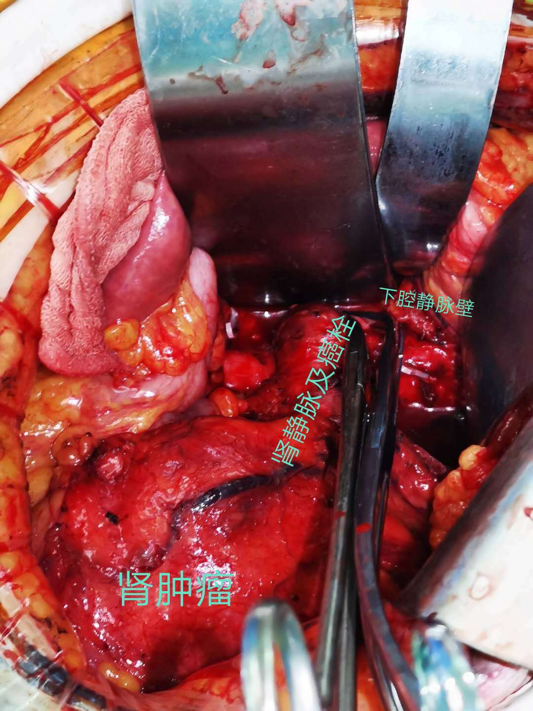 左肾癌伴左肾静脉0b级癌栓手术治疗 - 好大夫在线