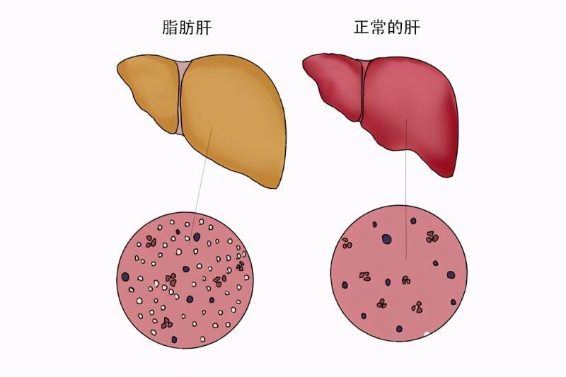 輕度脂肪肝不在意3年後肝硬化晚期做到這3點消除脂肪肝