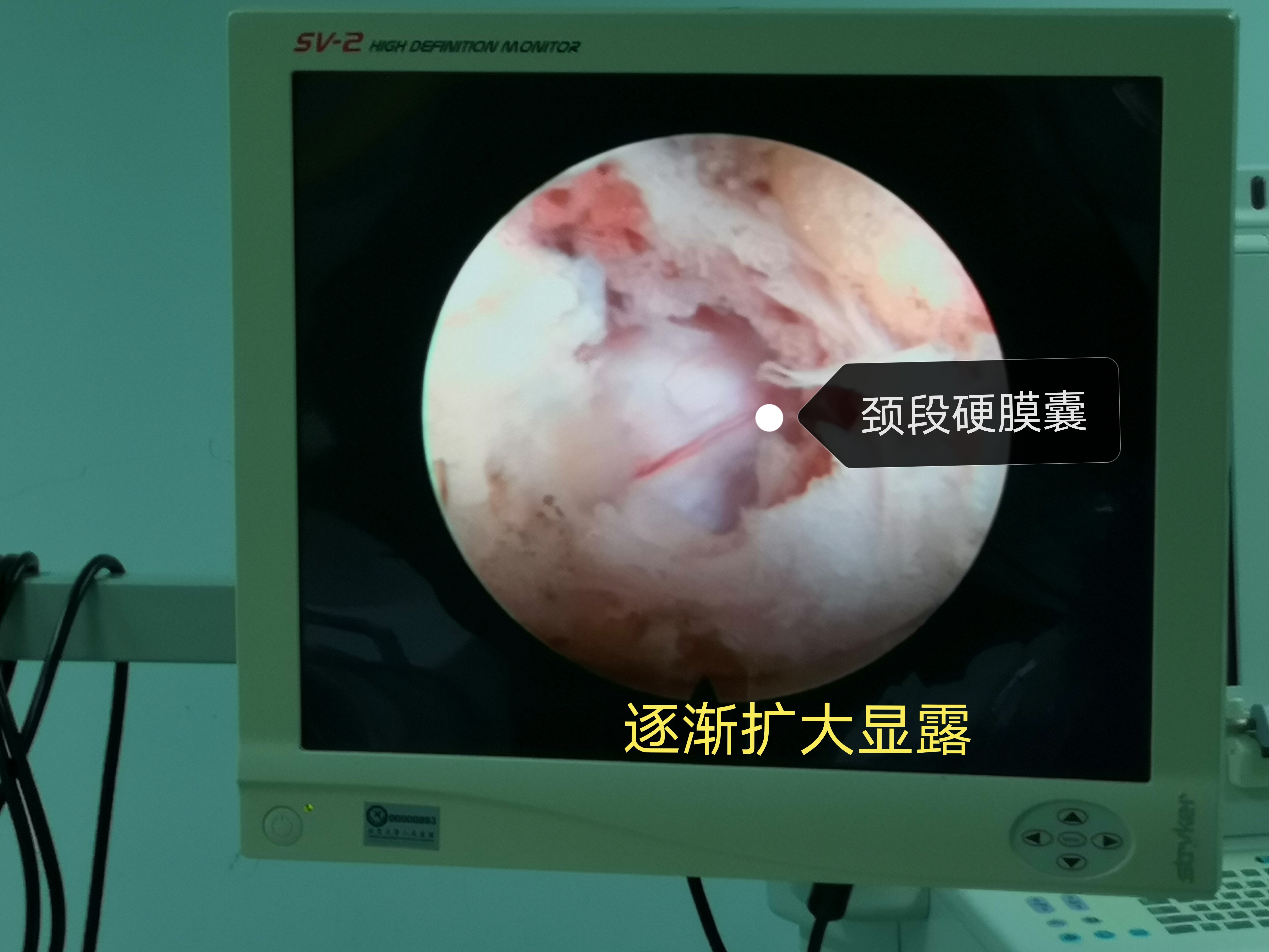 颈椎病内镜微创手术 - 好大夫在线
